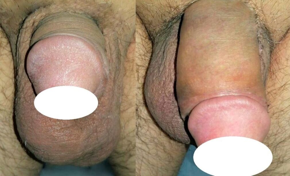 Fotos vor und nach der Penisvergrößerung.